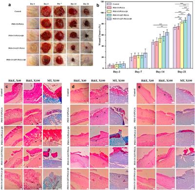 Levofloxacin loaded poly (ethylene oxide)-chitosan/quercetin loaded poly (D,L-lactide-co-glycolide) core-shell electrospun nanofibers for burn wound healing